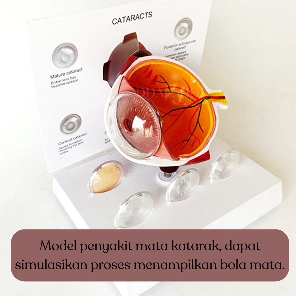 Alat Peraga Anatomi Bola Mata Manusia Katarak Human Anatomy Cataract Eye Model - Foto 5